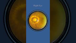 Smartphone Fundus Videography  Fundus Photography [upl. by Malloy]