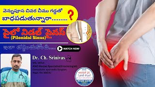 Ayurvedic Solutions for Pilonidal Sinus DrChSrinivasSahithi Ayurvedic Piles Hospital  Hyderabad [upl. by Ait]