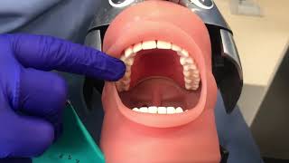 Anterior Rubber Dam placement amp removal [upl. by Elyk]