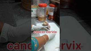 Cancer cervix specimen grossing pathology cancer cervicaltreatment cervicalcancersymptoms [upl. by Yzzo]