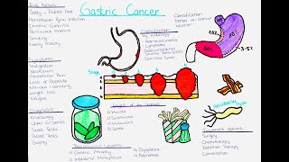 Understanding Gastric Cancer risk factors symptoms diagnosis treatment precancerous lesions [upl. by Eed]