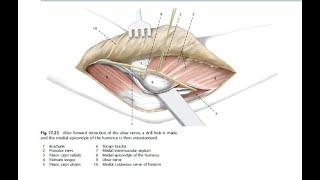 Medial Approach to the Elbow [upl. by Erreip]