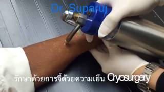 รักษาหูด กระเนื้อ ติ่งเนื้อ โดยการใช้วิธีการจี้เย็น Cryosurgery หมอรุจชวนคุย Cryotherapy [upl. by Rbma]