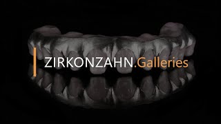 Prettau® 4 Anterior® zirconia on titanium  ZirkonzahnGalleries [upl. by Riaj]