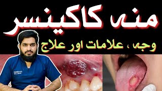 ORAL CANCER  Symptoms  Causes  Treatment  منہ کا کینسر  Urdu  Hindidrmuneermalik [upl. by Grega]