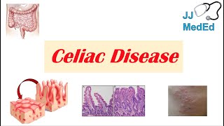 Celiac Disease amp Gluten Sensitivity Risk Factors Pathogenesis Symptoms Diagnosis Treatment [upl. by Assyral]