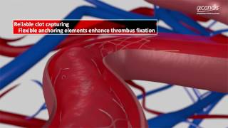 Product Animation Aperio® Thrombectomy Device [upl. by Rhianna]