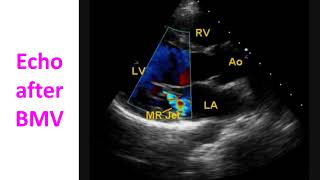 Echocardiogram after Balloon Mitral Valvotomy [upl. by Giulietta322]