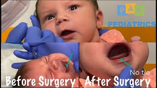 TONGUE TIE SURGERY ON ADORABLE 7 DAY OLD  PAK Pediatrics [upl. by Dnomal]