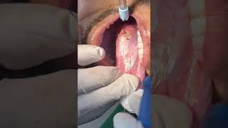 LEUKOPLAKIA REMOVAL [upl. by Meeharbi]