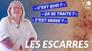 Lulcère de la peau le zona en 5 questions [upl. by Grane]