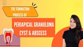 FORMATION PROCESS OF PERIAPICAL GRANULOMA CYST amp ABSCESS SIMPLIFIED FLOW CHARTNEETMDSPREPARATION [upl. by Neitsabes]