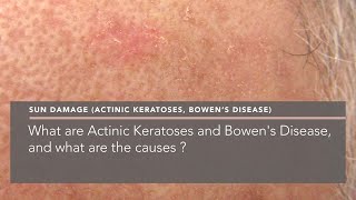 What are Actinic Keratoses and Bowens Disease and what are the causes [upl. by Alton]