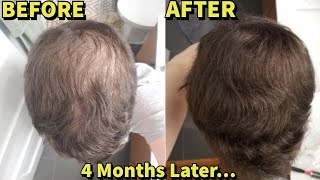 He Was Microneedling WITHOUT FinasterideMinoxidil For 4 MonthsSHOCKING Results [upl. by Nathanil]