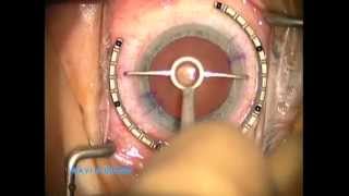 22 Astigmatism Management for Modern LensBased Surgery Part 22 [upl. by Kcinomod]