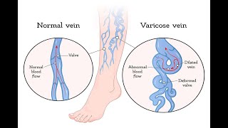 Varicose veins test’s [upl. by Kathy]