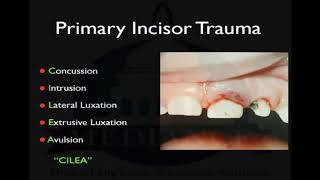 Primary Incisor Trauma  mediance academy [upl. by Thatcher338]