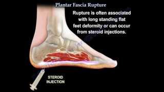 Plantar Fascia Rupture  Everything You Need To Know  Dr Nabil Ebraheim [upl. by Trefor954]