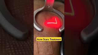 Laser Treatments for Acne Scars  Acne Scar Treatments fractional laser prpforface shorts [upl. by Roseanne798]