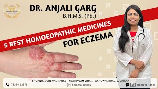 Best homeopathic medicines for Eczemaएक्जिमा का जड़ से इलाजDERMATITISDR ANJALI GARGHOMOEO HANDS [upl. by Caines]