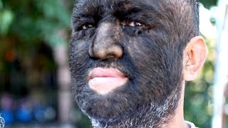 Meet the Worlds Hairiest Man [upl. by Kare981]