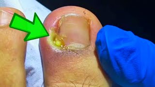 The WORST Infected Toenail Removal Youve Ever Seen [upl. by Mala]