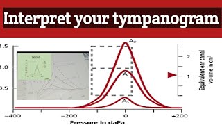 Tympanometry test  Tympanogram interpretation  how to read tympanogram selflessmedicose [upl. by Namie]