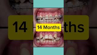 Orthodontics Case 14 Month Restoration [upl. by Nakah]