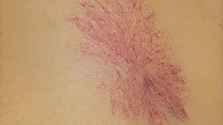 Spider Angioma  Spider Nevus  Nevus Araneus  Vascular Spider [upl. by Kwang]