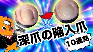 爽快！巻き爪矯正改善集〜深爪の陥入爪編〜【巻き爪先生 Vol5 】by Pincer Nails treatment Center®︎ [upl. by Ebeneser899]