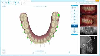 ALIGNERS ROTATION TIPS [upl. by Haizek]