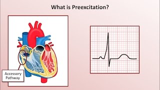 Advanced EKGs  WolffParkinsonWhite WPW Syndrome [upl. by Thelma]