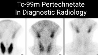 Stomach Colon and thyroid Cancer Detection by 99mTC Pertechnetate [upl. by Yenruoj]