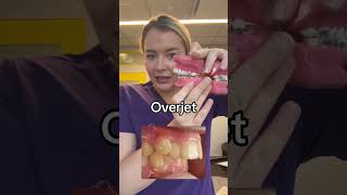 Overjet vs overbite braces overbite overjet [upl. by Aleahcim]