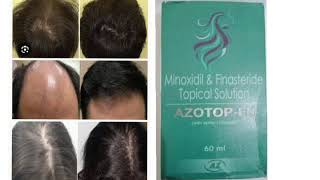 AZOTOP FN Topical Solution Minoxidil amp Finasteride Topical Solution [upl. by Ranger]