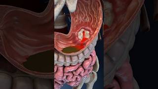 STOP Ignoring These Gastric Ulcer Symptoms Bleeding gastric ulcer 3D animation from VOKA [upl. by Bricker]