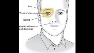 Cluster Headache [upl. by Ecirtac527]