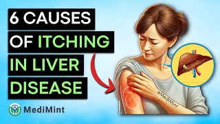 Top 6 Causes of Itching In Liver Disease [upl. by Cerys]