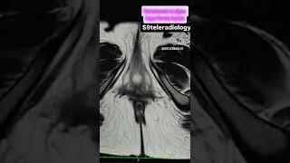 Hematometrocolpos due to Imperforate hymen amenorrhea menstrualpain cryptomenorrhoea mri usg [upl. by Idnir856]