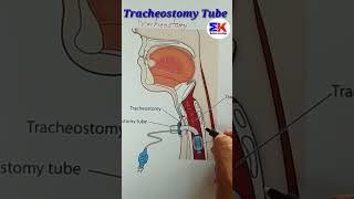 tracheostomy Tube shorts [upl. by Nollek]