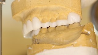 Tips and Tricks Diagnostic Dental Wax Ups [upl. by Mailli]