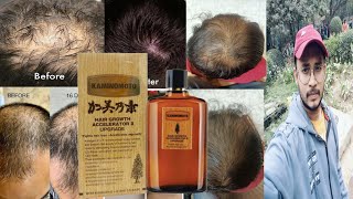 kaminomoto hair growth accelerator 2 upgrade  honest review [upl. by Nilla816]