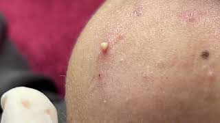 Many small pimples on the skin  Acne Treatments Mai Ngoc 💕💕💕 [upl. by Igenia]