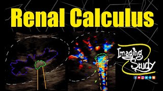 Renal Calculus  Nephrolithiasis  Ultrasound  Case 274 [upl. by Asenab64]