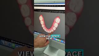 Invisalign to close spaces and gaps [upl. by Hosfmann164]