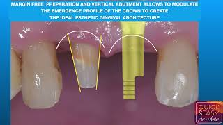 BOPT TECHNIQUE COMPARED TO QUICKampEASY PROCEDURE [upl. by Ainahtan]