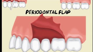 Periodontal Flap [upl. by Burton]