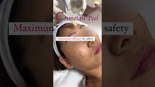 Say Goodbye to pigment with Cosmelan Peel Treatment pigmentation cosmelan [upl. by Coady676]