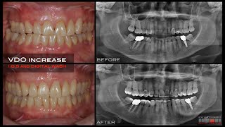 WORN DENTITION JIG for Deprogrammed Passively Retruded DPR Position Intra Oral Scanner and BOPT [upl. by Traweek82]