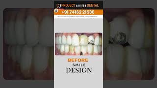 Smile Designing in Hyderabad  Before amp After  Project Smiles Dental Hyderabad ytshots smilemore [upl. by Evad65]